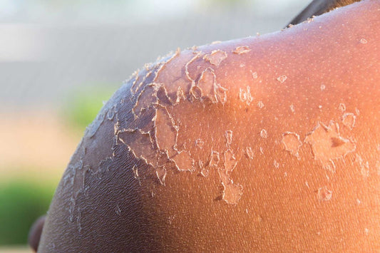 Sun burn 101: How to treat sunburn to nourish the skin and prevent peeling