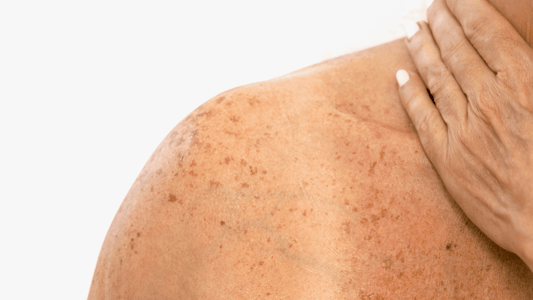 Ultimate Guide to Hyperpigmentation: Types, Causes & What to do - Tropic Labs